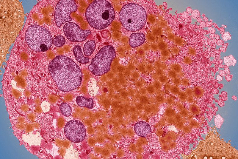 Colored transmission electron micrograph (TEM) of a bladder cancer cell stained orange. The cell is large and has many nuclei (purple).