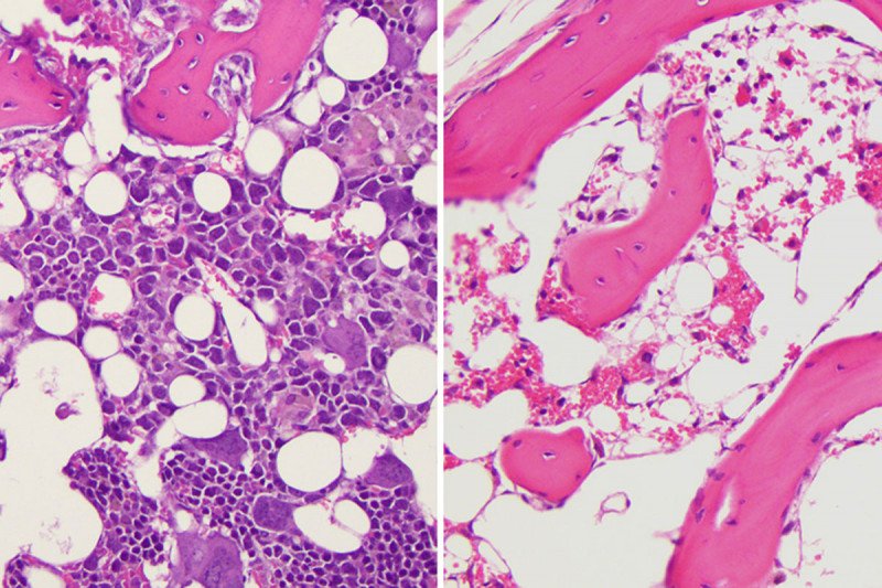 side-by-side bone marrow slides showing different levels of immune cell growth