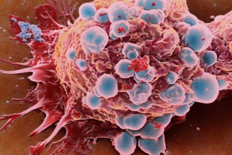 Microscopic view of a breast cancer cell