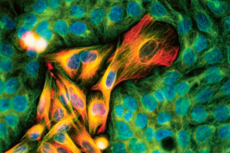 mmunofluorescent light micrograph of melanoma cancer cells