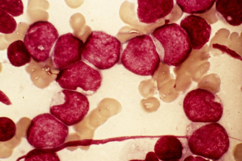 Leukemia cells