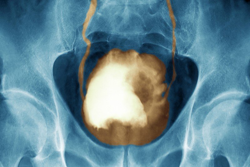 x-ray of bladder with large tumor