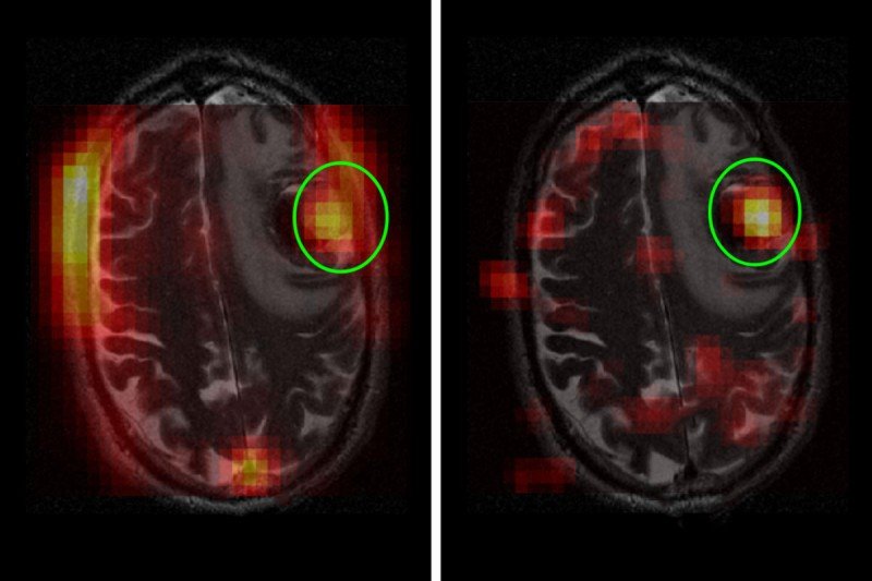 Side-by-side images of brain MRIs.