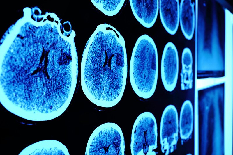 CT scans of brains