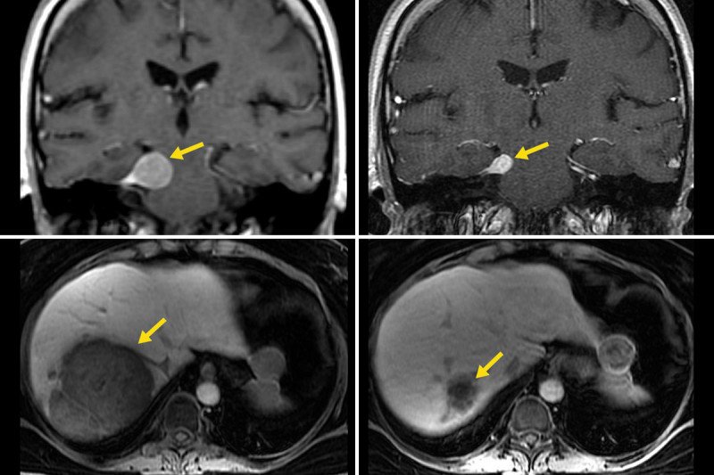 Scans of Immunotherapy performed on tumors