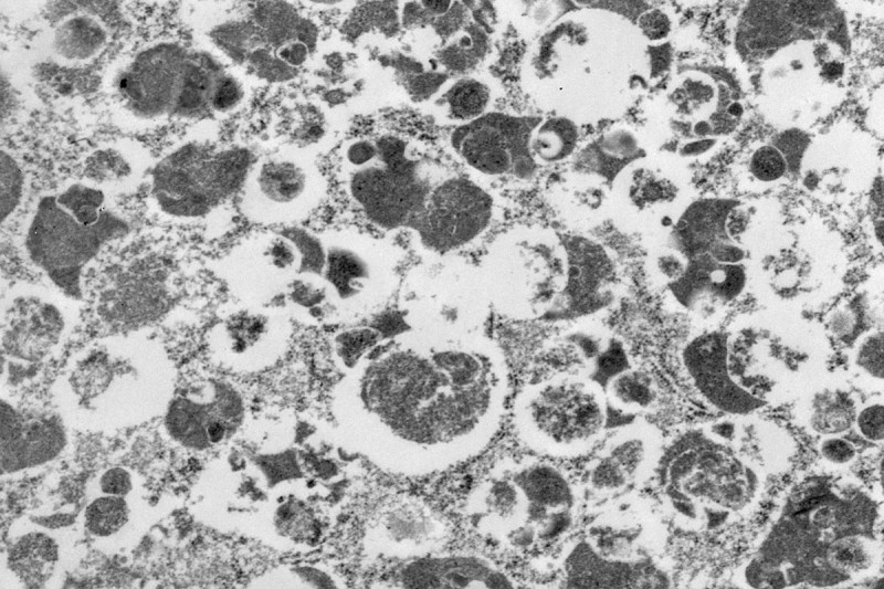 Black-and-white microscopic image of cell from human granular cell tumor