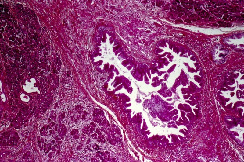 Pancreatic tumor cells