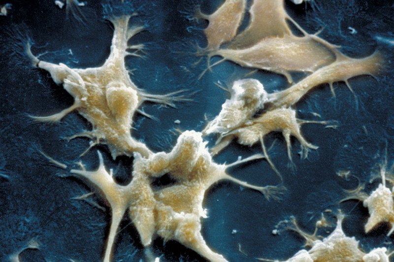 Microscopic image of prostate cancer cells in culture.