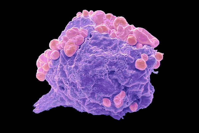 Colored scanning electron micrograph of a lymphoma cell showing early apoptotic changes