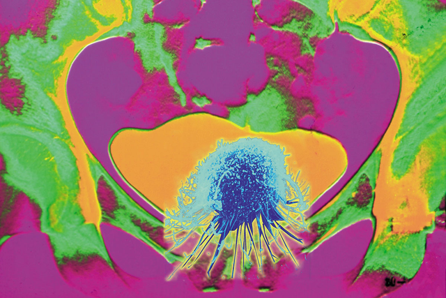 Conceptual orange-and-green-colored X-ray showing cancer of the bladder. 