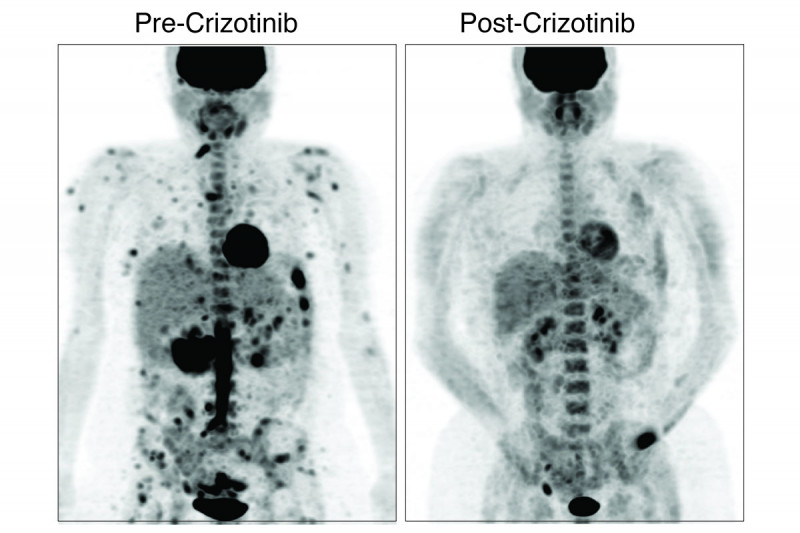 Two images of a human torso show a reduction in tumors after treatment with targeted therapy.