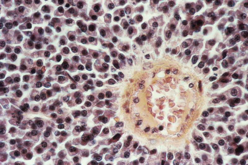 Micrograph of multiple myeloma cells