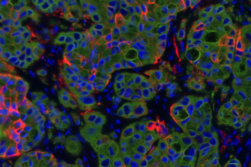 Section of a lung cancer tumor in mice