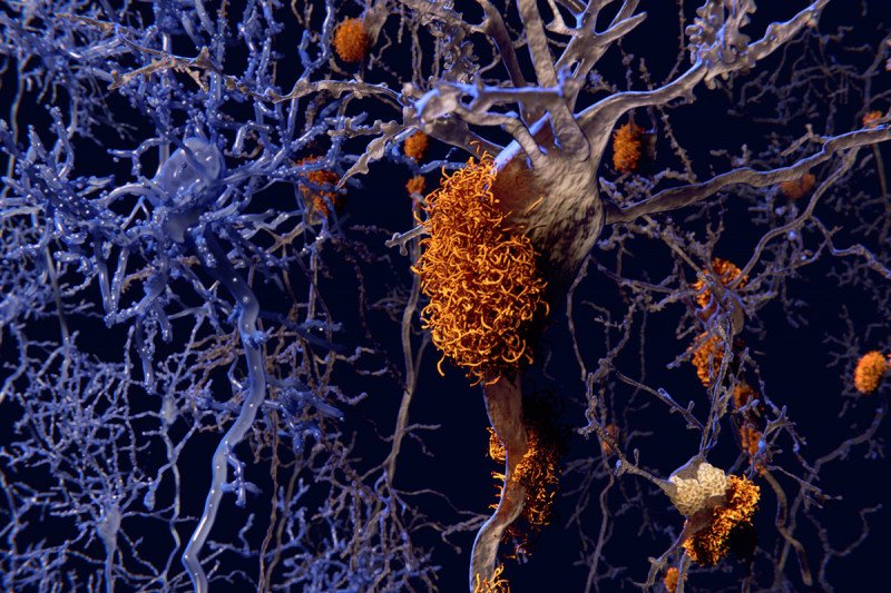 An illustration of a beta-amyloid plaque among the neurons in a brain.
