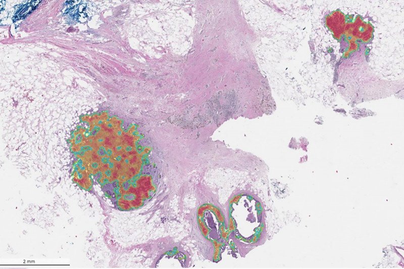 A section of breast tissue with cancerous changes identified.