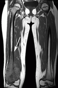 This is an MRI image of the thighs of a person who has osteosarcoma. The arrow points to the diseased area in the leg; the other leg appears to be unaffected.