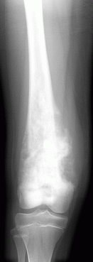 This is an x-ray of the thigh just above the knee showing an osteosarcoma. The arrow points to the whiter region, which is the tumor.