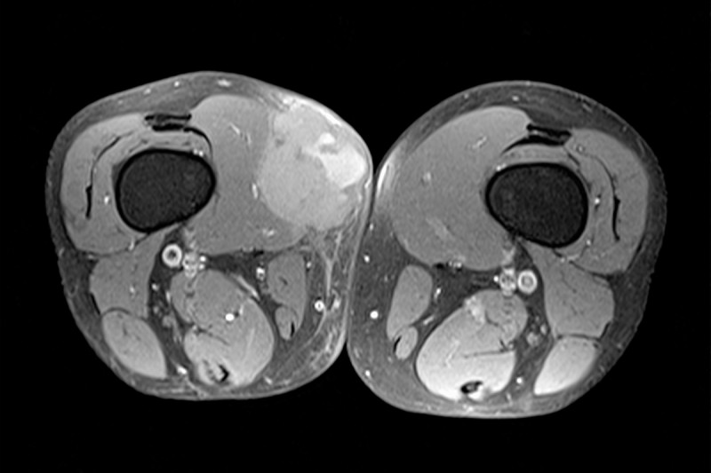 Adoptive Cell Therapy Improves Outcomes for Select Patients With Advanced Synovial Sarcoma