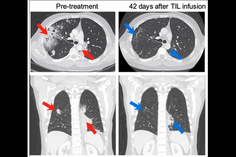CT scans of a patient's chest illustrate how cancer has shrunk after treatment.