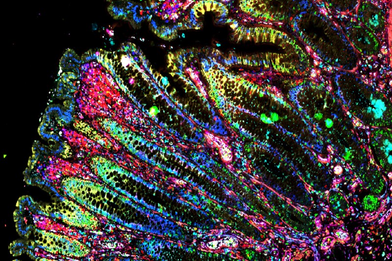Image of colon tissue harboring an early neoplastic lesion (Credit: Almudena Chaves-Perez, Lowe Lab)
