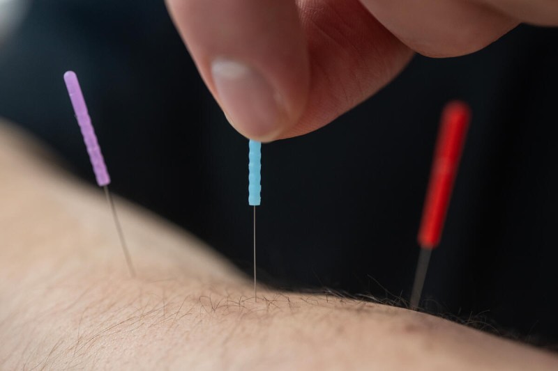 A close-up of fingers inserting acupuncture needles into skin.