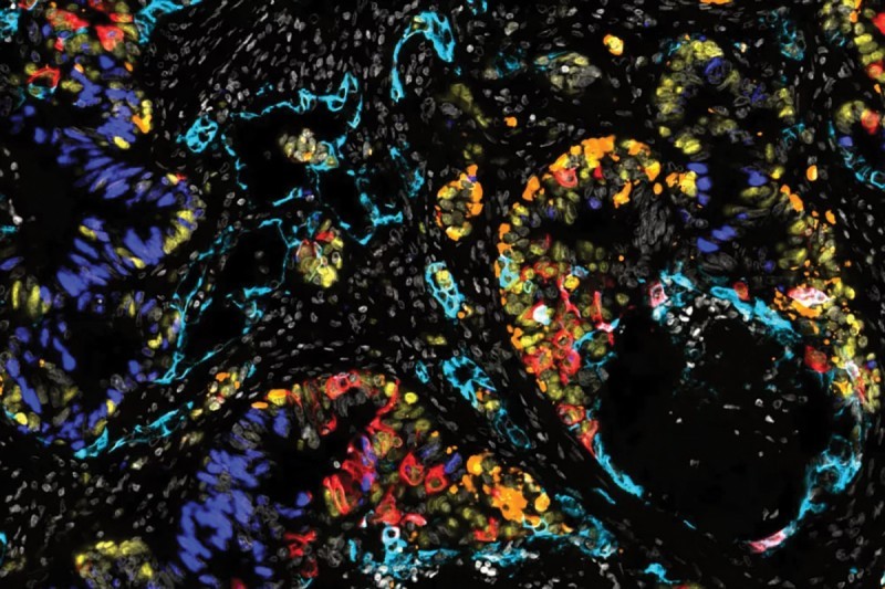 This fluorescent image of a patient’s colorectal cancer liver metastasis shows the diversity of cell states from normal intestinal states