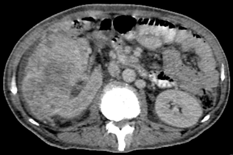 MSK Researchers Demonstrate Improved Survival for Previously Treated Patients with Advanced Renal Cell Carcinoma With Novel Combination Therapy