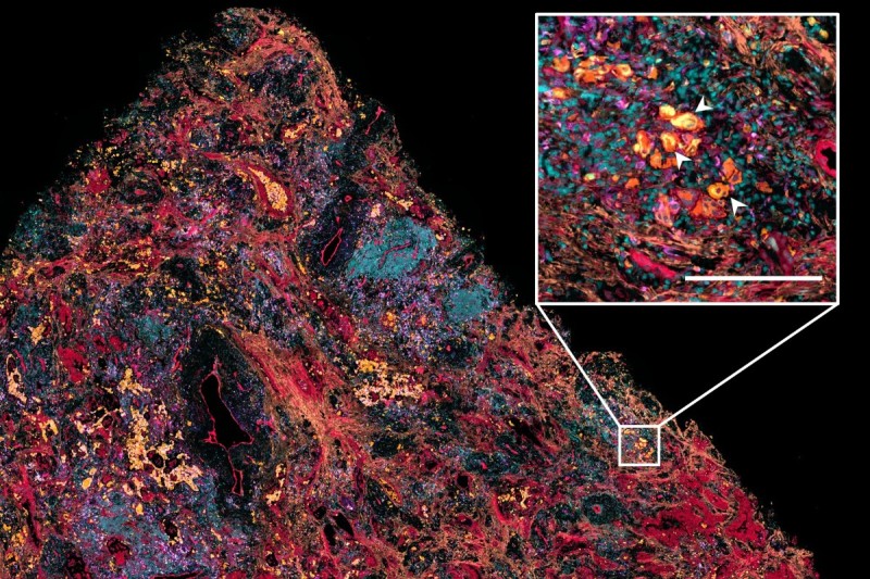 scientific image of lung cancer