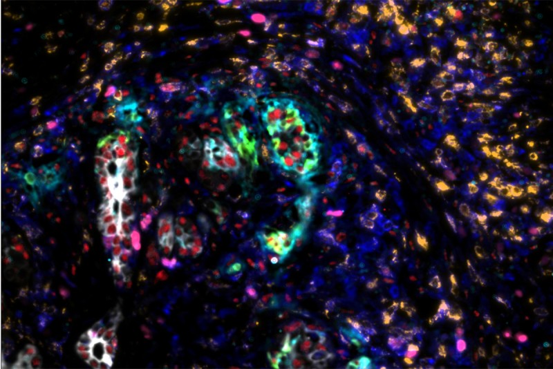 Multiplex IF images showing a high-grade PanIN adjacent to tumor, showing a lesion expressing progenitor markers (KRT17 and TP53) surrounded by a uPAR+ and TNC+ stroma, and by CD8+ cells.  Scale bars: 100 µm.