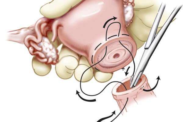 After the cerclage suture is added, the uterus is sutured back to the vagina, and the reproductive tract continues like normal. If the patient becomes pregnant after the surgery, she would be able to have a full-term pregnancy and give birth by cesarean section.