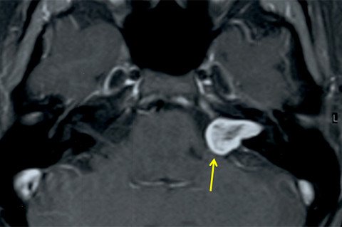 MRI image with yellow arrow pointing to an acoustic neuroma.