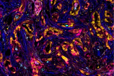 Multiplex immunofluorescence of post-chemotherapy treatment resistant human PDAC tumor shows uPAR (magenta) expressed across both tumor cells (P53, yellow) and stromal populations: fibroblasts (SMA, blue) and myeloid cells (CD68/CD11b, cyan), positioning uPAR as a potential pan-compartment CAR-T target within an immunosuppressive, fibrotic tumor microenvironment. Scale bars: 100 µm