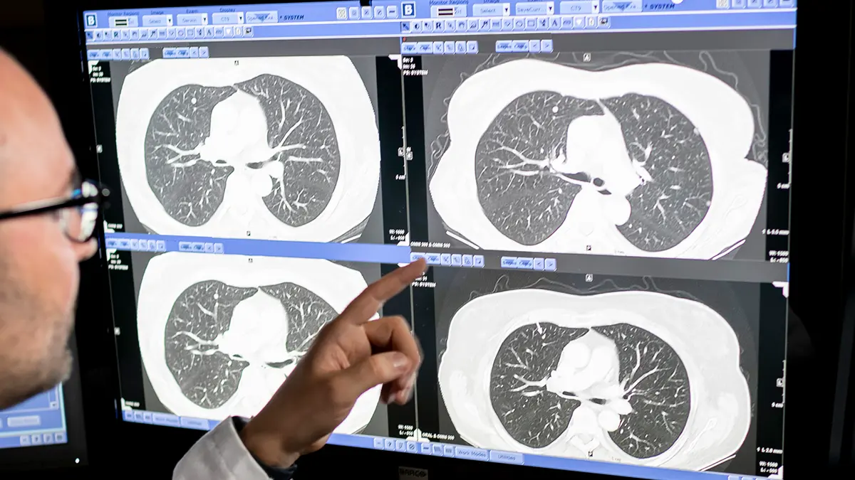 A computer screen displays four scans of lungs.