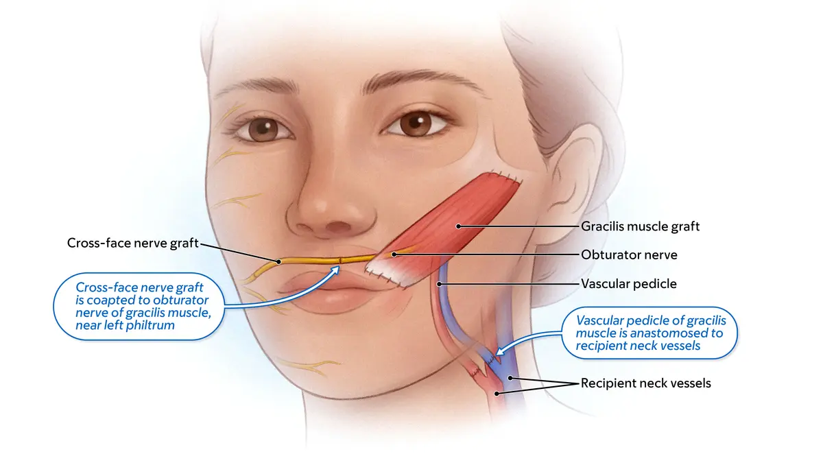 Drawing of gracilis muscle and nerve transfer used to restore facial movement. 