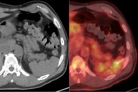 CT and PET/CT images of needle biopsy