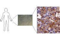 Histology images of stem cells and AML cells
