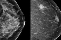 Video: Watch our experts explain breast density