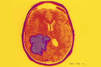 Enhanced MRI of a glioblastoma