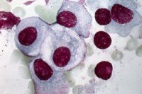 Light micrograph of multiple myeloma cells.
