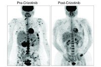 Two images of a human torso show a reduction in tumors after treatment with targeted therapy.
