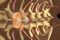 Epidural analgesia for patients with non-small cell lung cancer