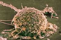 Scanning electron microscope image of a breast cancer cell.