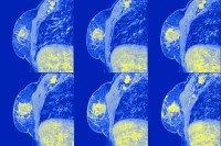 Select Patients With Early-Stage Breast Cancer May Safely Skip Post-Mastectomy Nodal Irradiation