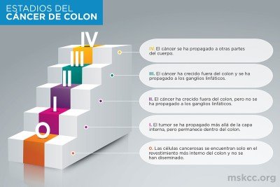 Infografía sobre los estadios del cáncer de colon