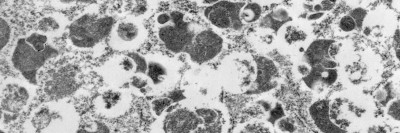 Black-and-white microscopic image of cell from human granular cell tumor