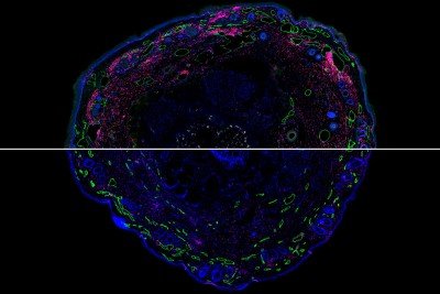 Confocal microscopic image of mouse lymphedema tissue with staining for immune cells and lymphatic vessels.