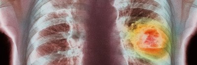 Colored x-ray of lung cancer