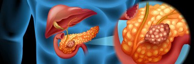 Illustration of human body with pancreas exploded to side and magnified. 