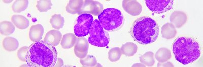 Acute myeloid leukemia cells under a microscope
