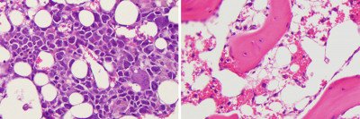side-by-side bone marrow slides showing different levels of immune cell growth